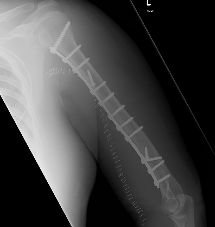 Humeral Plate Lateral